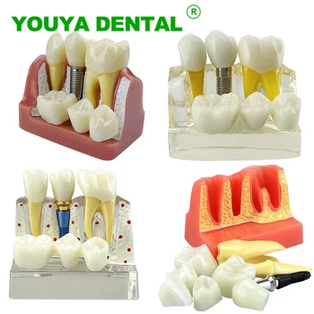 De 4 Ori Implant Dentar Model Demonstrativ Dinți Implant Analiza Coroana Pod Detașabil Model Pentru Dentist Elev Învață Studiu